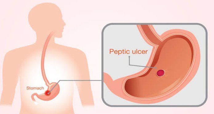 പെപ്റ്റിക് അൾസർ
